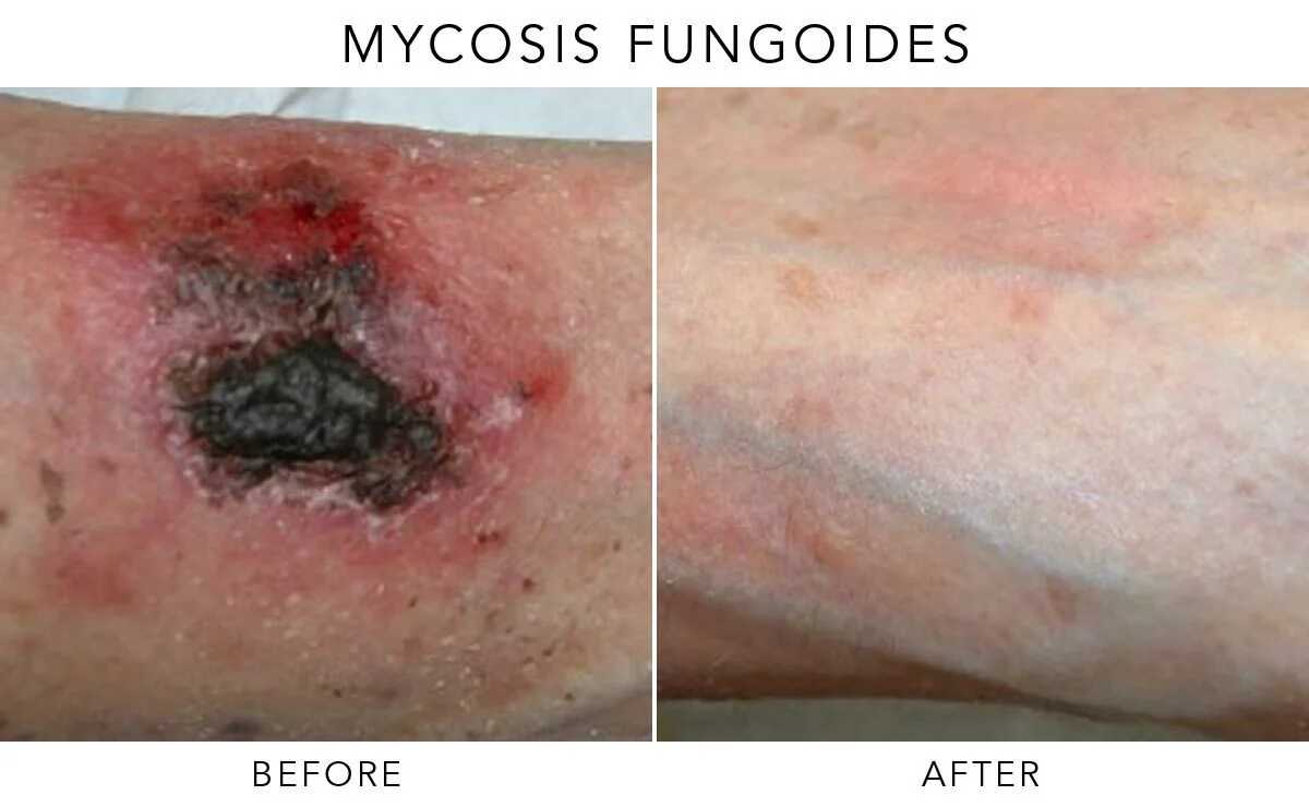Mycosis Fungoides Before-After-M02