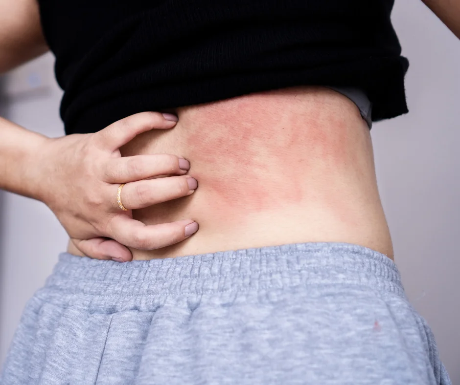 Woman Scratching a Mild Rash on Her Back
