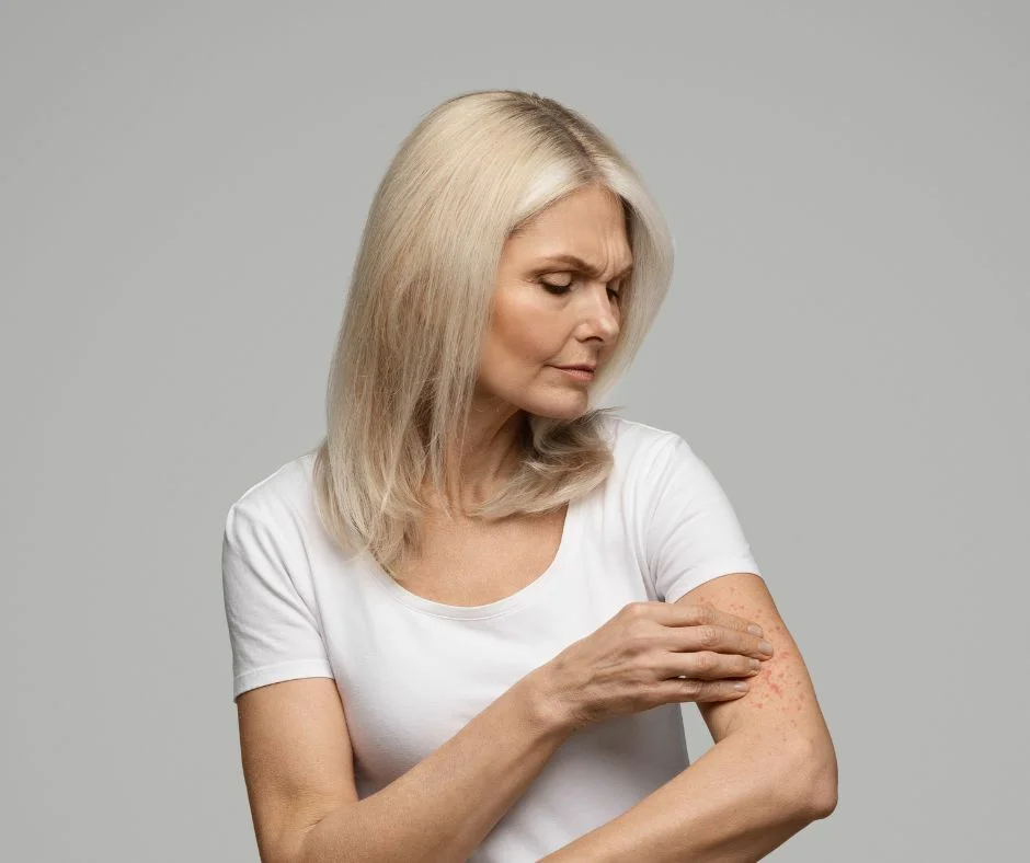 atopic dermatitis: woman with atopic dermatitis flare-up